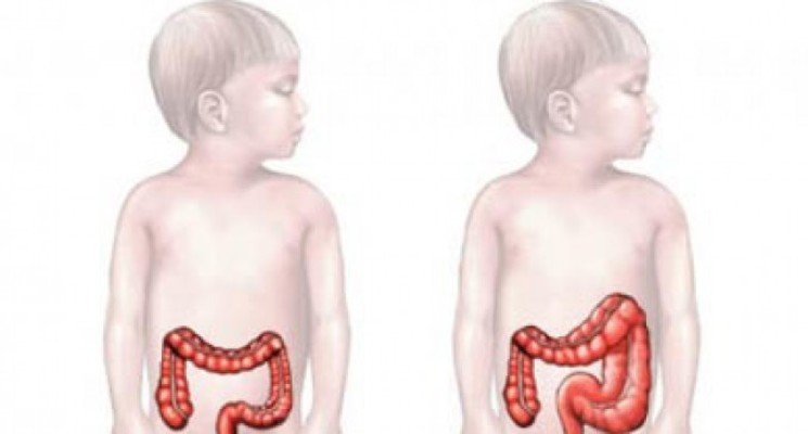 Симптомы долихосигмы кишечника у ребенка, лечение медикаментозными и народными средствами