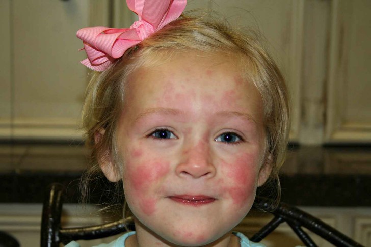 Как выглядит аллергия на коже ребенка: виды и симптомы с фото, лечение и профилактика аллергических реакций