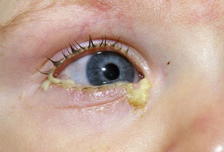 Особенности лечения конъюнктивита у ребенка 2-3 лет, симптомы заболевания глаз с фото и профилактика