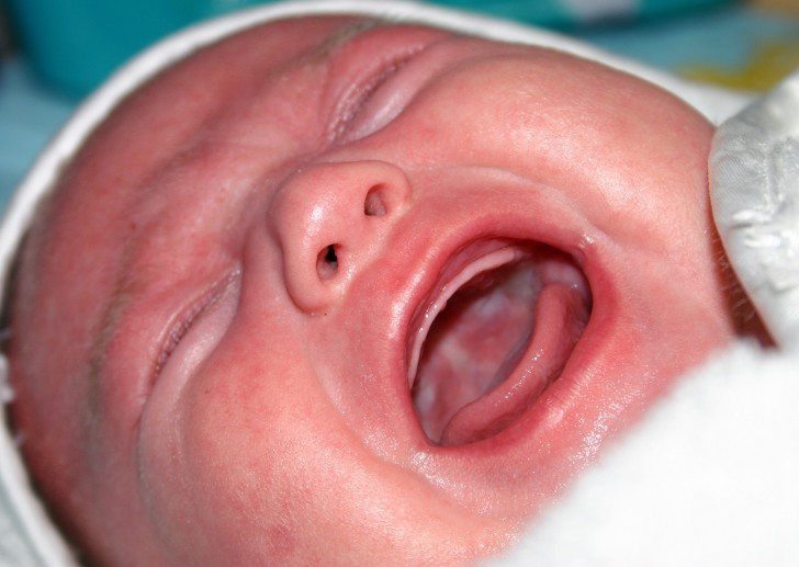 Симптомы стоматита у грудничка с фото и принципы лечения заболевания у новорожденных в домашних условиях