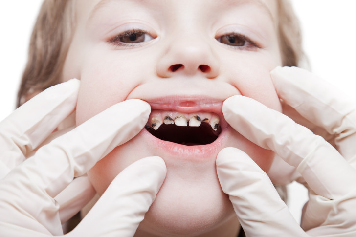 Лечение и профилактика кариеса молочных и постоянных зубов у детей в раннем возрасте