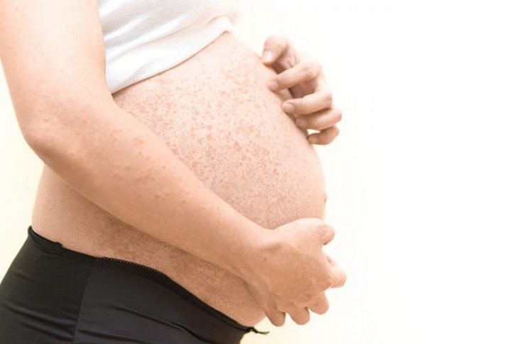 Гестоз и его признаки при беременности: что это такое и каковы его причины, в чем опасность патологии и как ее лечить?