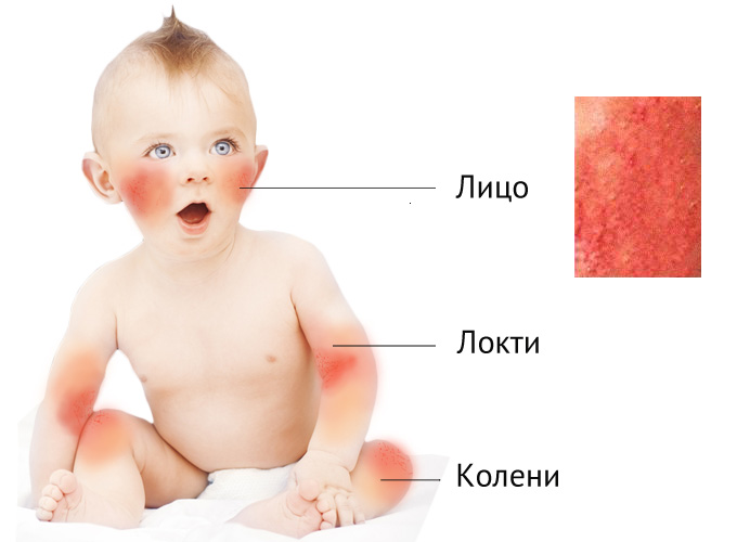 Причины атопического дерматита у детей, симптомы заболевания с фото и особенности лечения