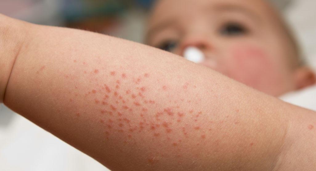 Почему у ребенка сыпь в виде гусиной кожи на лице и теле: причины и лечение