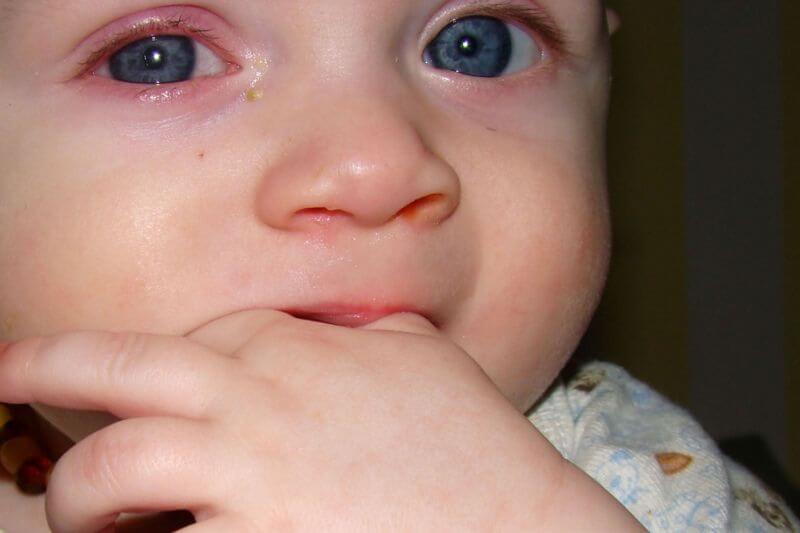 Как выглядит аллергия на лице грудничка: фото сыпи, симптомы и способы лечения