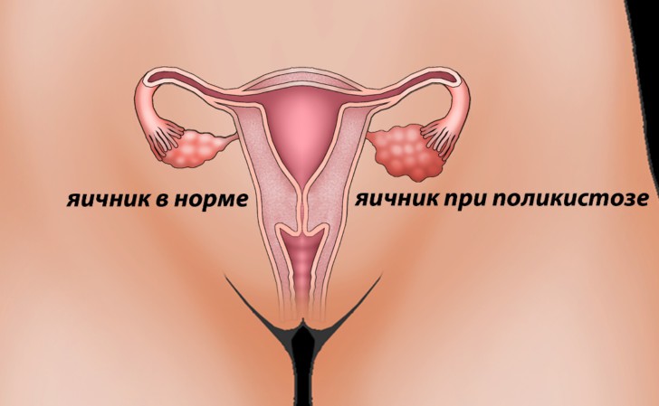 Понятие и симптомы поликистоза яичников, вероятность наступления беременности, особенности лечения