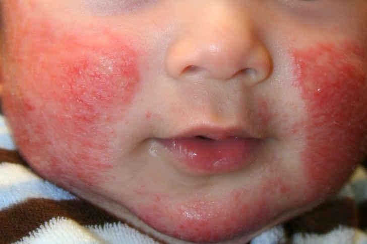 Мази и кремы от аллергии на коже у детей: лучшие гормональные и негормональные средства