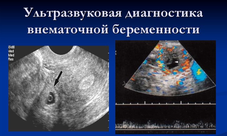 Внематочная беременность на каком сроке можно определить и видно ли по фото на УЗИ?