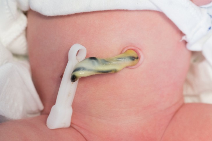 Причины выпадения пуповины во время родов и последствия для матери и ребенка