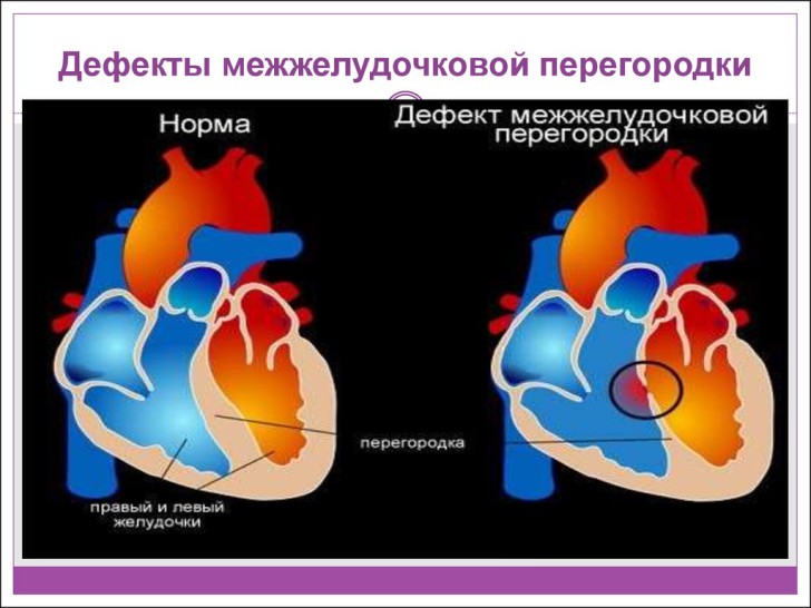 У новорожденного мышечный дефект межжелудочковой перегородки в сердце: каковы последствия и лечение ДМЖП?