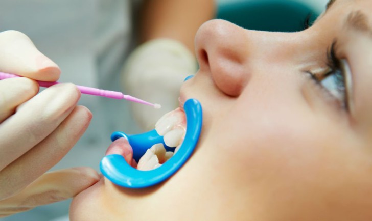 Фторирование молочных и постоянных зубов у детей: фото и описание процедуры