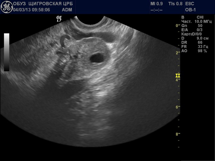 Виды желтого тела в яичнике: что это такое, какие размеры имеет при овуляции и беременности, как определяется на УЗИ?