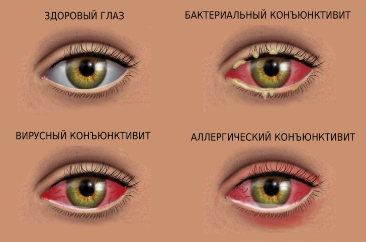 Особенности лечения конъюнктивита у ребенка 2-3 лет, симптомы заболевания глаз с фото и профилактика