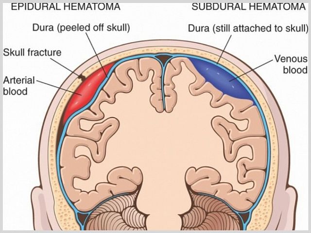 Гематома в голове после удара: последствия, лечение