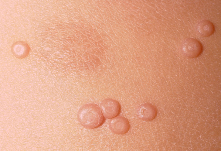 Контагиозный моллюск на коже у детей: фото и причины патологии, лечение на начальной стадии и удаление