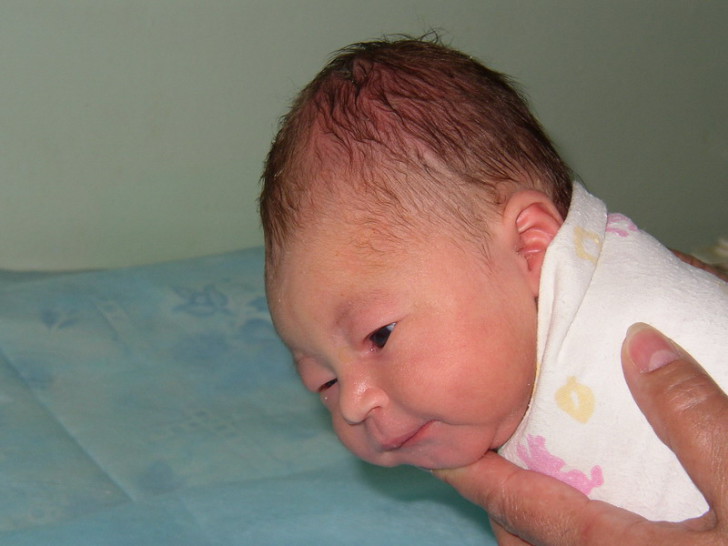 Причины возникновения гематомы у новорожденного на голове после родов, особенности лечения и последствия