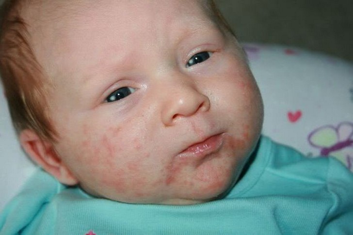Симптомы золотистого стафилококка у детей, способы передачи и лечение инфекции