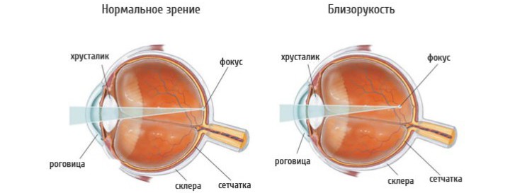 Что такое склеропластика глаз, какие есть за и против для выполнения операции детям?