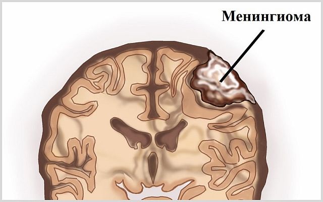 Менингиома головного мозга - что это такое