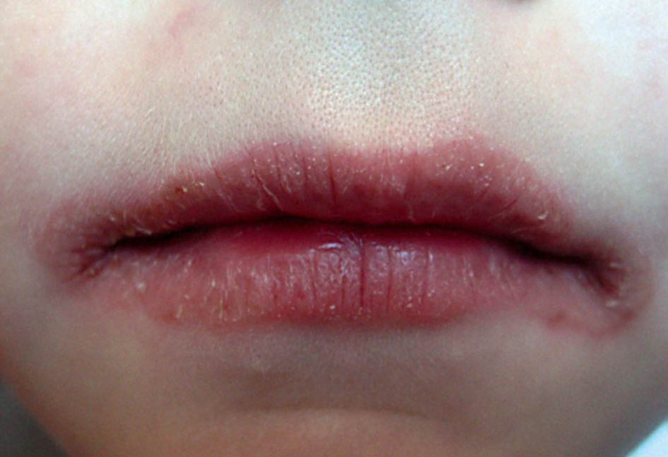 Заеды в уголках рта у детей: причины, симптомы с фото и способы лечения