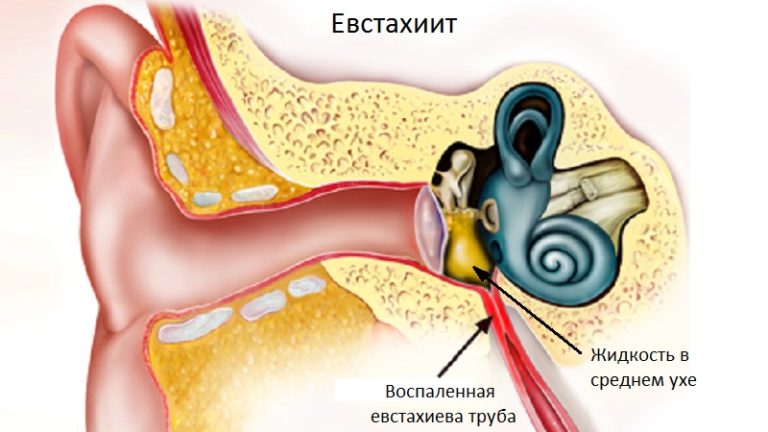 Что такое тубоотит: симптомы и лечение двустороннего и одностороннего заболевания уха у детей