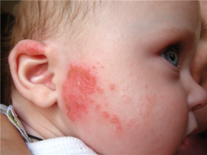 Причины появления сыпи на шее у ребенка, распространяющейся на лицо, уши и плечи