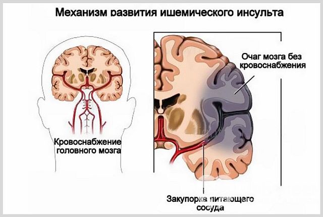 Хроническая ишемия (ишемическая атака) головного мозга
