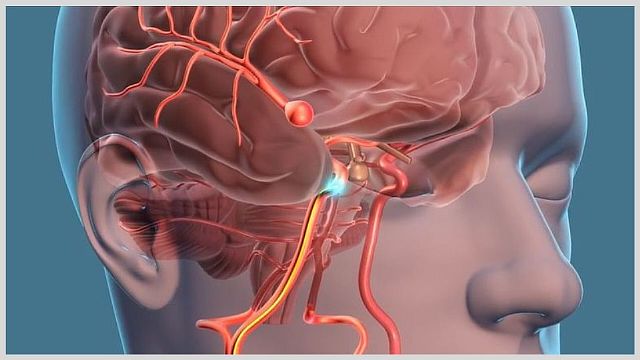 Что такое аневризма головного мозга и ее последствия