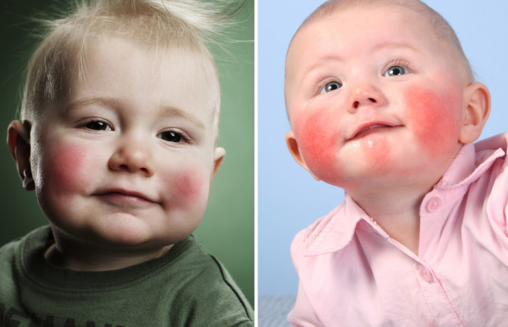 Симптомы инфекционной эритемы у детей с фото: как распознать и чем лечить болезнь?