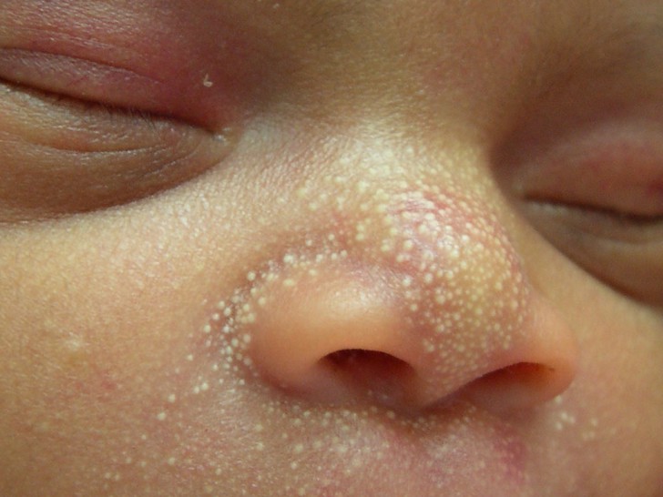 Все виды сыпи на лице у детей с пояснениями и фото: причины появления прыщиков и способы лечения