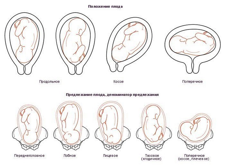 Упражнения для беременных перед родами, чтобы ребенок перевернулся вниз головой при тазовом предлежании
