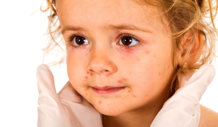 Причины появления сыпи у ребенка на подбородке: раздражение от слюней, аллергия и другие проблемы