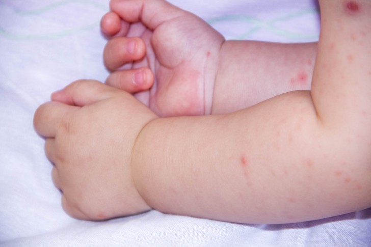 Мелкая сыпь на руках и ногах у ребенка: виды и фото прыщиков с пояснениями