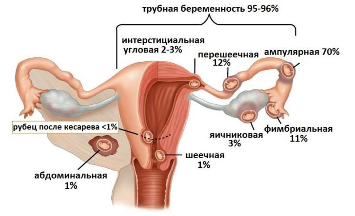Симптомы внематочной беременности: причины и признаки на ранних сроках, последствия и лечение