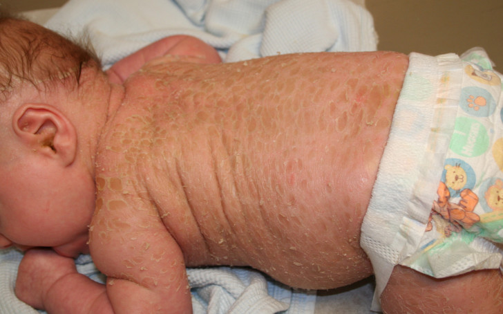 Ихтиоз кожи у новорожденных детей: опасно ли это заболевание, что делать и как лечить малыша?