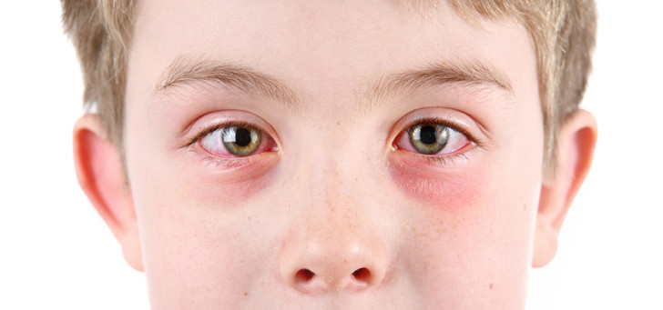 Что делать, если у ребенка покраснели глаза: причины и лечение, сопутствующие симптомы и профилактика