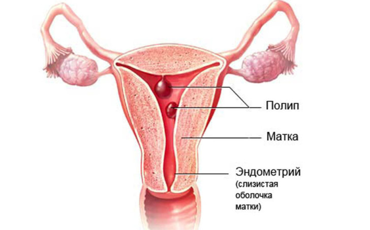 Полип на шейке матки на ранних и поздних сроках беременности: может ли кровить, что делать, чем опасен?