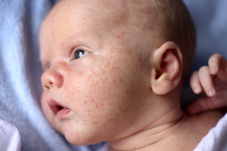 Причины появления сыпи на шее у ребенка, распространяющейся на лицо, уши и плечи