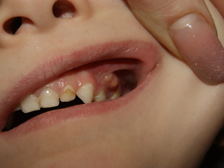 Что делать с флюсом на десне молочного зуба: причины и лечение у детей разного возраста