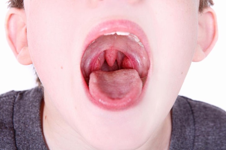 Как выглядит здоровое и больное красное горло у ребенка, какими в норме должны быть миндалины?