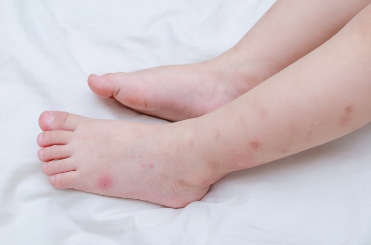 Почему у ребенка на ногах и по телу без причины появляются синяки что это может быть?