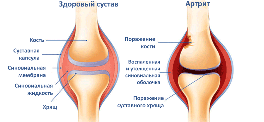 Причины возникновения артрита коленного сустава у детей, симптомы и лечение