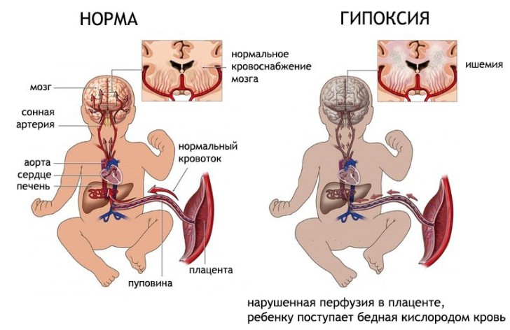 Симптомы гипоксии головного мозга у новорожденных, лечение и последствия постгипоксических изменений у ребенка