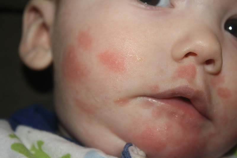 Какими симптомами у ребенка проявляется аллергия на глютен, и когда она пройдет?