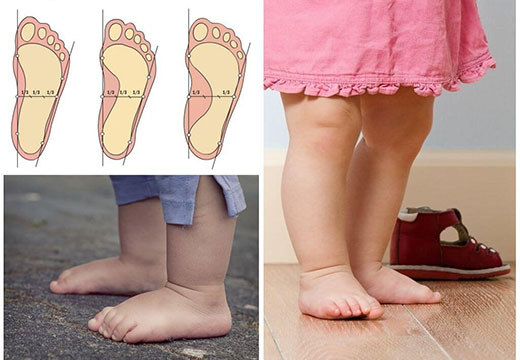 деформация стопы у ребенка