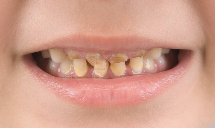 Процедура серебрения молочных зубов у детей при кариесе: преимущества метода и альтернативы