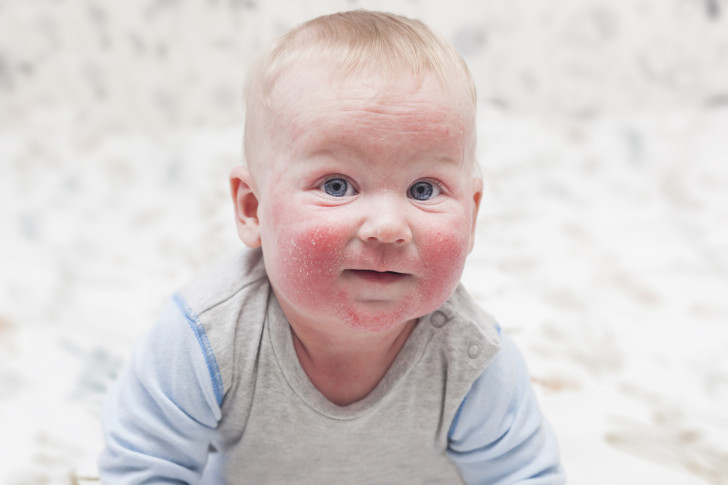 Симптомы и схема лечения аллергического дерматита у детей до года и старше