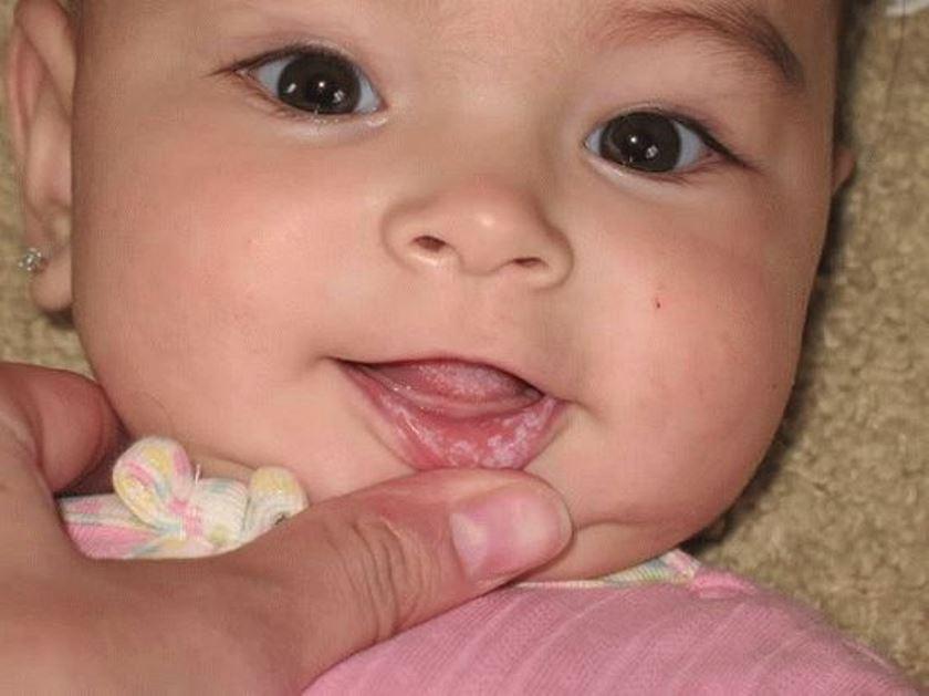 Кандид: инструкция по применению раствора для полости рта новорожденным и детям старшего возраста