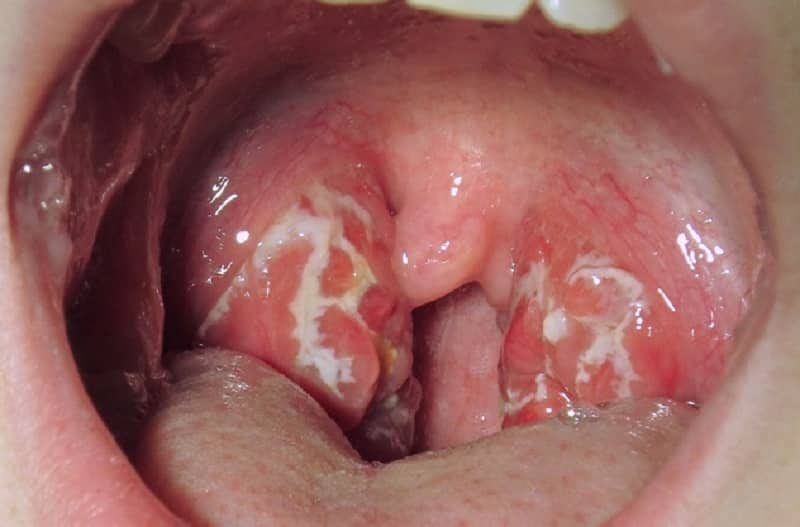 У ребенка в горле белый налет что означает такой симптом и чем лечить воспаление?