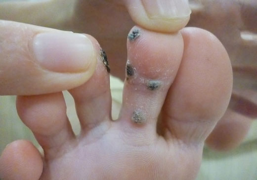 Бородавки между пальцами ног